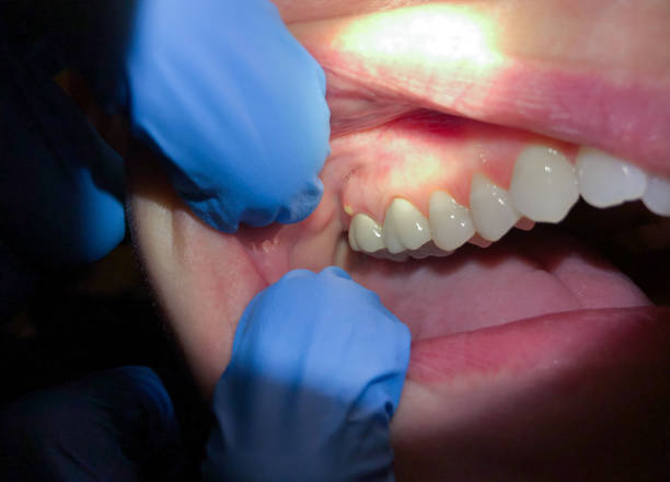 Best Cracked Tooth Emergency Dentist  in Saylorsburg, PA